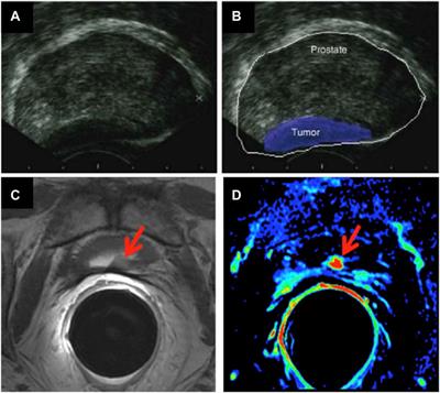 Corrigendum: Nano-Theranostics for the Sensing, Imaging and Therapy of Prostate Cancers